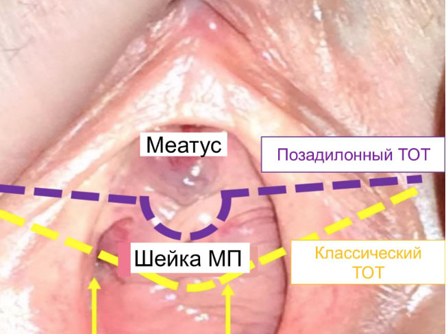 опухоль почки