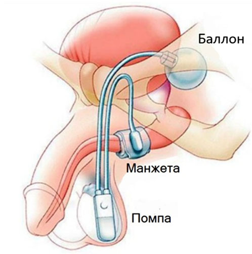 Искусственный мочевой сфинктер AMS 800: схема устройства с манжетой вокруг уретры, регулирующим баллоном и насосом в мошонке для контроля мочеиспускания