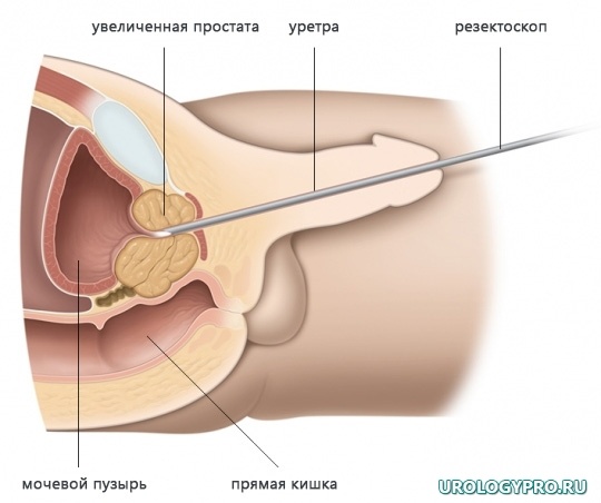 HoLEP осуществляется с помощью микроэндоскопической техники через мочеиспускательный канал