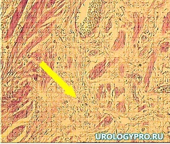 pozdniy-gidronefroz1