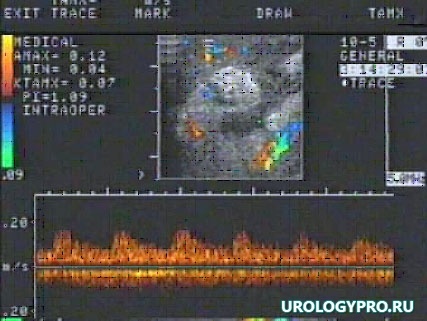 pozdniy-gidronefroz10b