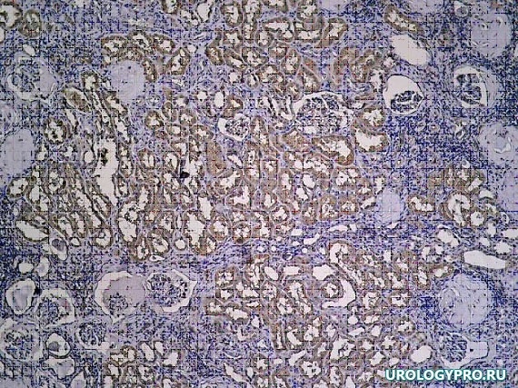 pozdniy-gidronefroz12g