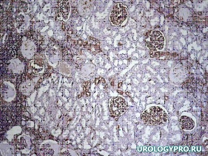 pozdniy-gidronefroz12v
