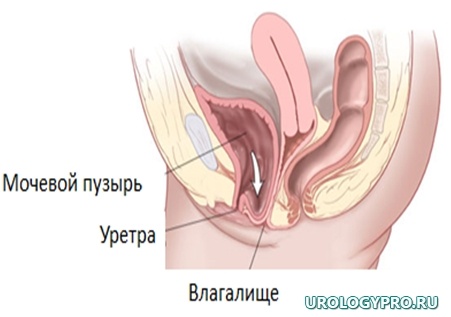 Цистоцеле: через опущенную переднюю стенку влагалища выпадает мочевой пузырь